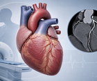 TARGETCTCA Found No Benefit for Routine CT Coronary Angiography