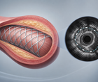 ivus guidance in complex high risk pci fails to lower tvf