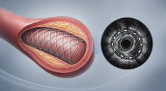 ivus guidance in complex high risk pci fails to lower tvf