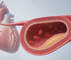intensive ldl cholesterol targeting in atherosclerotic cardiovascular disease