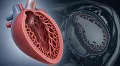 LV Hypertrabeculation Not Linked to Worse DCM Prognosis