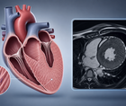 trientine in hypertrophic cardiomyopathy phase 2 trial