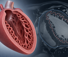 LV Hypertrabeculation Not Linked to Worse DCM Prognosis