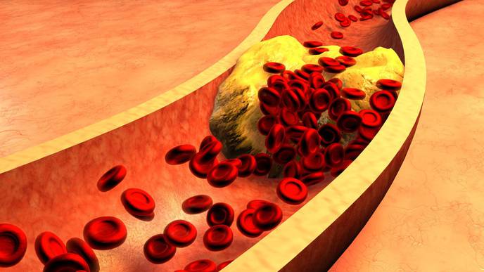 U.S. FDA Updates LDL-C Lowering Indication For Esperion’s NEXLETOL ...