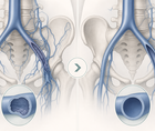 c tract trial endovascular therapy lowers pts severity improves qol