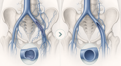 c tract trial endovascular therapy lowers pts severity improves qol