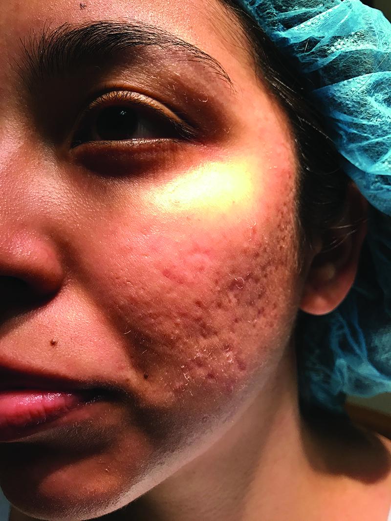 Fig 1. A 23-year-old female patient presents with rolling and boxcar scars. Fig 1