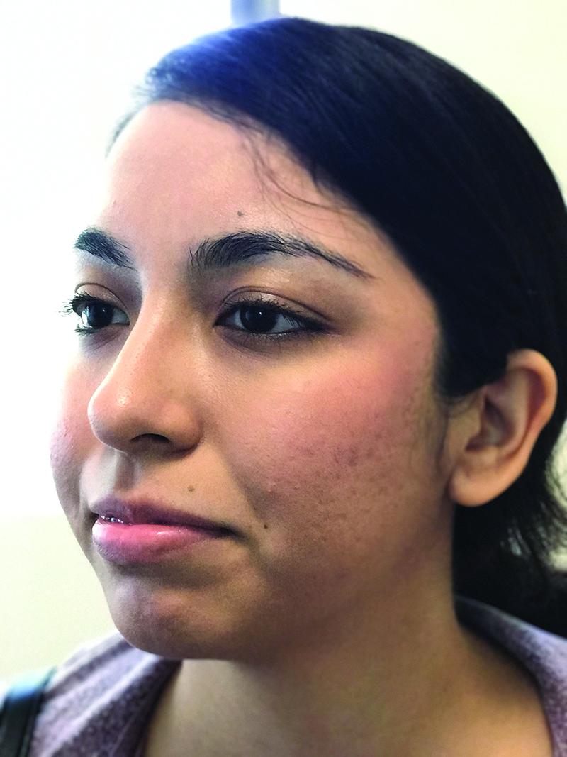 Fig 2. The patient’s scarring is mostly resolved following treatment with with CO2 laser resurfacing, subcision, fillers, and radiofrequency microneedling. Fig 2