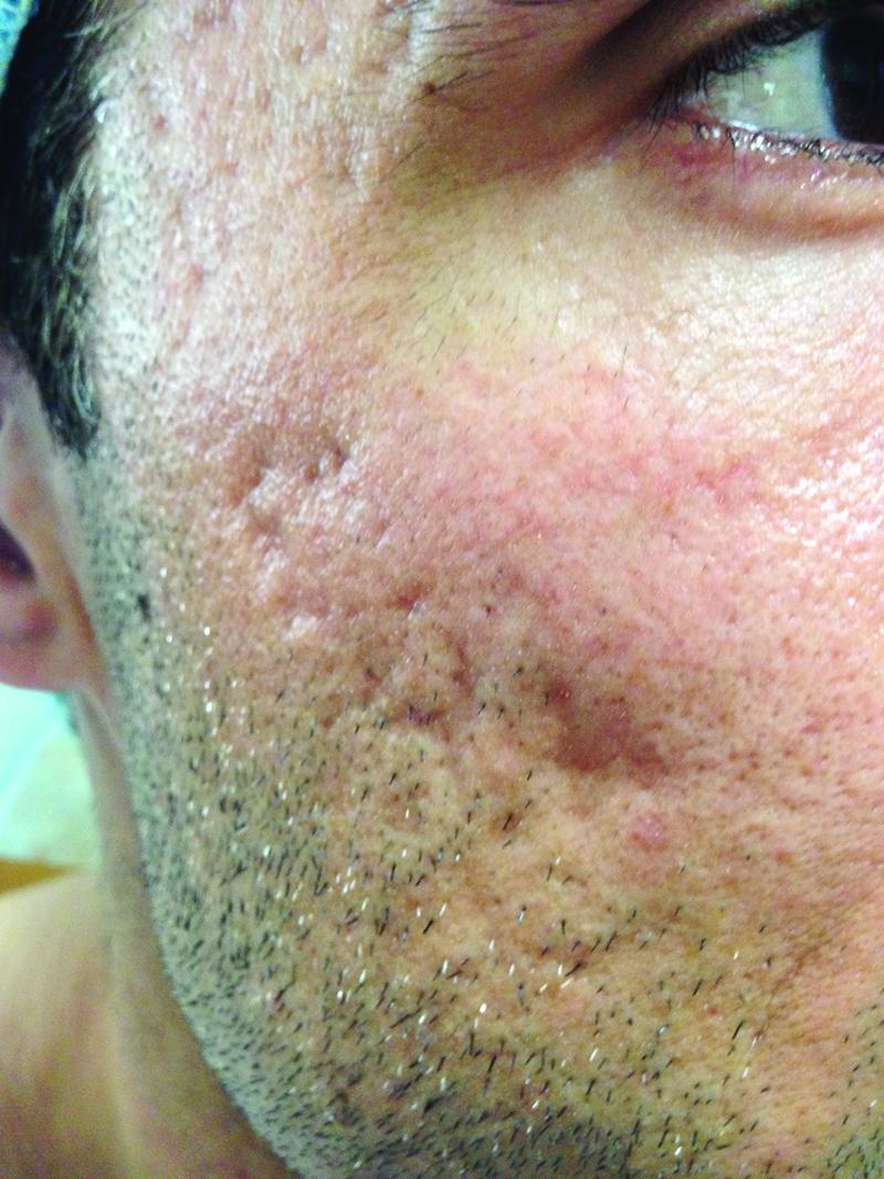 Fig 3. A male patient in his 30s presents with deep atrophic and rolling acne scars. Fig 3