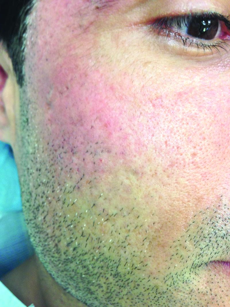 Fig 4. The patient’s scarring is mostly resolved following treatment with with CO2 laser resurfacing, subcision, fillers, and radiofrequency microneedling. Fig 4