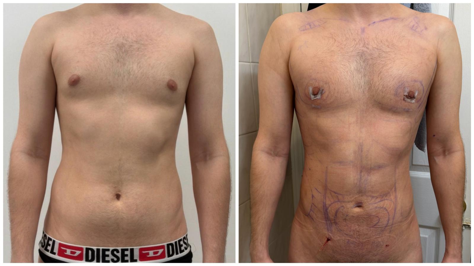 Figure 1. Preoperative frontal view demonstrating mild gynecomastia with chest fullness and adiposity involving the abdomen and flanks. Figure 1