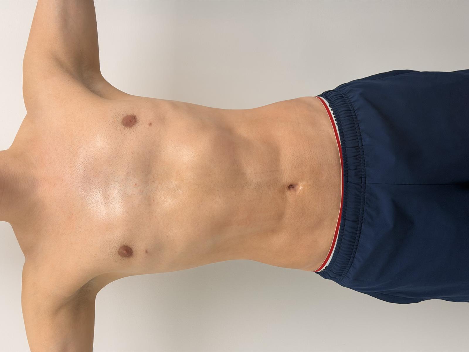 Figures 3 through 10. Before-and-after photographs from four different views, with the postoperative ones taken more than 3 months after the procedure. Figures 3 through 10